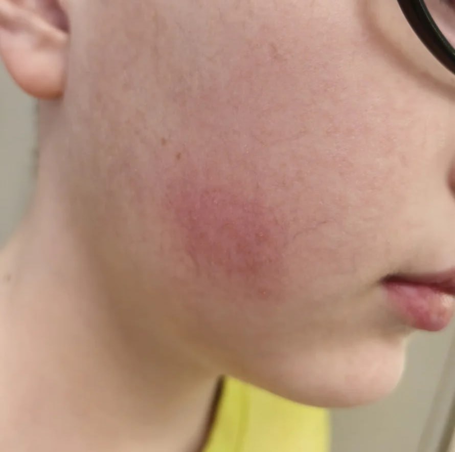 Тошнота, диарея и высыпания: тульский школьник попал в больницу после пачки сока Тошнота, диарея и высыпания: тульский школьник попал в больницу после пачки сока